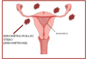 Endometriose - Dr Gilson Gusmão